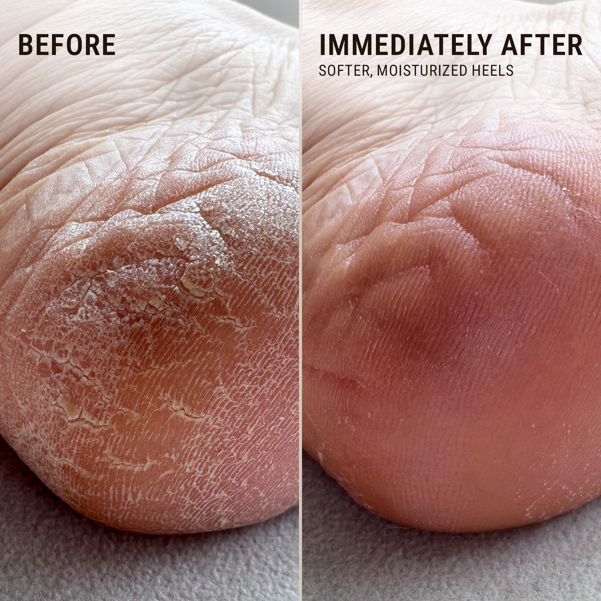 Heel Repair Foot Care Kit | VOESH